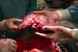 Ортотопічна трансплантація печінки: показання, протипоказання