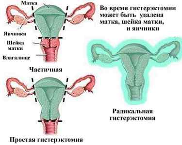 Основні показання для видалення матки при міомі (відгуки пацієнток)