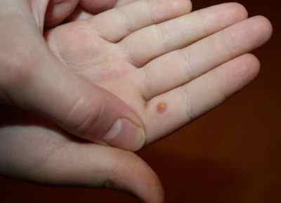 Основні симптоми і причини виникнення бородавок на руці у дитини. Чи небезпечні новоутворення?