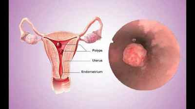 Основна симптоматика і лікування поліпозу ендометрія (матки)