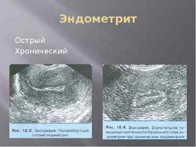 Основна симптоматика і способи лікування патології внутрішнього шару матки - ендометриту