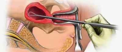 Особливості чищення матки при ендометріозі