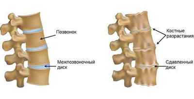 Остеоартроз хребта: симптоми і лікування, профілактика і класифікація, рентгенологічні стадії, можна вилікувати | Ревматолог