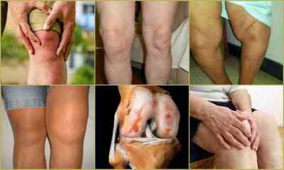 Остеоартроз колінного суглоба 12 3 ступеня: лікування, симптоми, причини