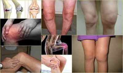 Остеоартроз колінного суглоба 12 3 ступеня: лікування, симптоми, причини