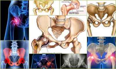 Остеоартроз кульшового суглоба 12 3 ступеня: лікування, симптоми, причини