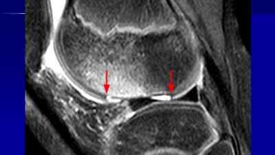 Остеоартроз периферичних суглобів і хребта: симптоми і лікування, профілактика | Ревматолог