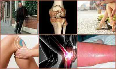Остеофіти колінного суглоба: що це таке, причини, симптоми, лікування