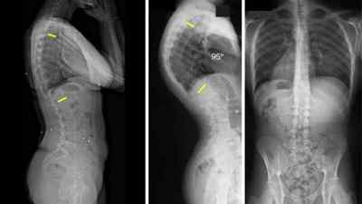 Остеохондропатия хребта: наслідки, вправи при ОХП грудного відділу хребта, МКБ 10 хондропатії у дітей | Ревматолог