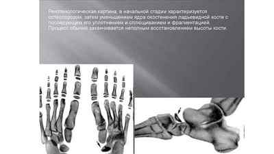 Остеохондропатия стопи: човноподібної, таранної і головки 2 плеснової кісток | Ревматолог