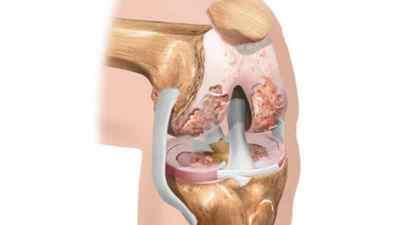 Остеохондроз колінного суглоба 1 і 2 ступеня: симптоми і лікування народними засобами, електрофорез з димексидом на коліно | Ревматолог