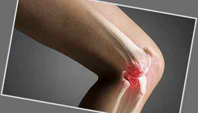 Остеохондроз колінного суглоба 1 і 2 ступеня: симптоми і лікування народними засобами, електрофорез з димексидом на коліно | Ревматолог