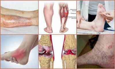 Остеохондроз ніг: причини, симптоми, лікування