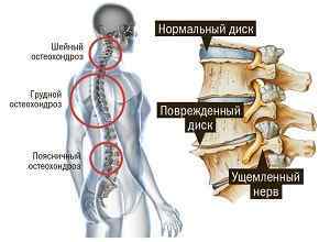 Остеохондроз попереково-крижового відділу хребта: симптоми і лікування, комплекс фізичних вправ, ознаки, що таке | Ревматолог