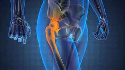 Остеохондроз тазостегнового суглоба: симптоми і лікування, остеохондроз стегна і хондроз | Ревматолог