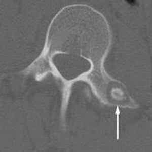 Остеома: що це таке, лікування лобової і стегнової кістки народними засобами, симптоми остеоід-остеоми потиличної кістки | Ревматолог