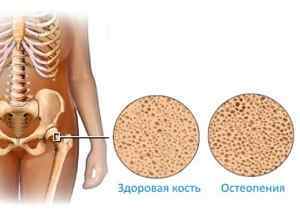 Остеопенічного синдром: що це таке, чим відрізняються остеопороз і остеопенія, остеопенія тазостегнового суглоба, МКБ 10 | Ревматолог