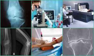 Остеопороз колінного суглоба: симптоми і лікування, причини, діагностика