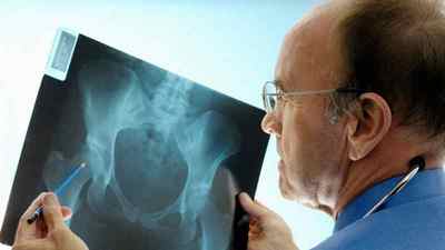 Остеопороз тазостегнового суглоба: симптоми і лікування, ознаки остеопорозу у жінок і чоловіків після 50 років, препарати та профілактика | Ревматолог