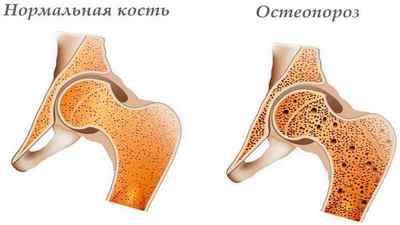 Остеопороз тазостегнового суглоба: симптоми і лікування, ознаки остеопорозу у жінок і чоловіків після 50 років, препарати та профілактика | Ревматолог