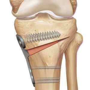 Остеотомія колінного і тазостегнового суглобів: відгуки та періацетабулярная остеотомія при дисплазії, реабілітація | Ревматолог