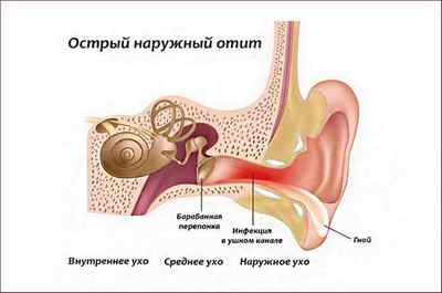 Отит вуха у дорослих: симптоми і лікування