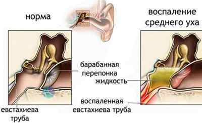 Отомікоз вуха: симптоми і лікування