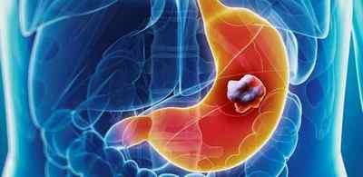 Ознаки раку шлунка: перші симптоми, як проявляє себе онкологія органу