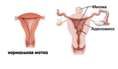 Ознаки та способи лікування міоми матки з аденоміозом