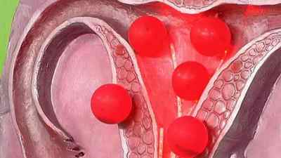Ознаки та способи лікування міоми матки з аденоміозом