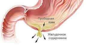 Ознаки виразки шлунка: перші симптоми, характерні для цього захворювання