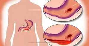 Ознаки виразки шлунка: перші симптоми, характерні для цього захворювання