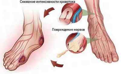 Пальці при діабеті: болі і оніміння в пальцях ніг і рук