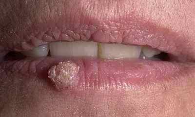 Папілома на губі: причини і принцип лікування захворювання