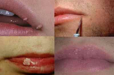 Папілома на губі: причини і принцип лікування захворювання