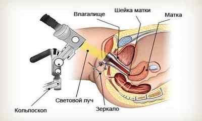 Папілома шийки матки: симптоми і способи лікування