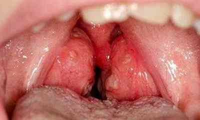 Папілома в горлі: симптоми, фото і лікування
