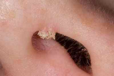 Папілома в носі: фото, причини, ознаки і лікування