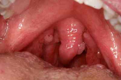 Папілома в роті: причини, лікування і профілактика