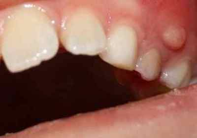 Папілома в роті: причини, лікування і профілактика