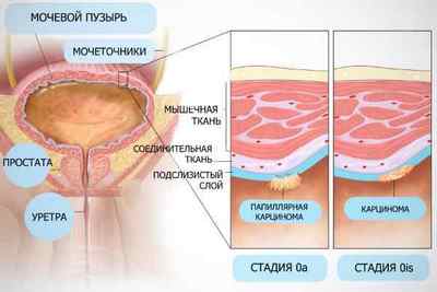 Папілома в сечовому міхурі: симптоми і лікування
