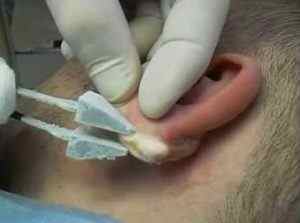Папілома в вусі: фото і методи лікування захворювання