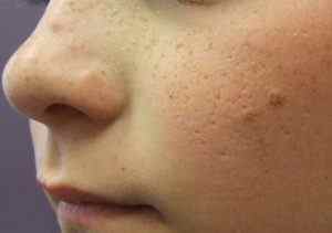 Папіломи на обличчі: причини і методи лікування захворювання