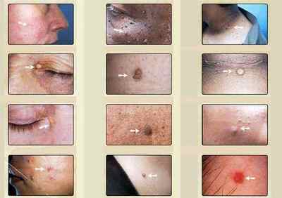 Папіломи на обличчі: причини і методи лікування захворювання