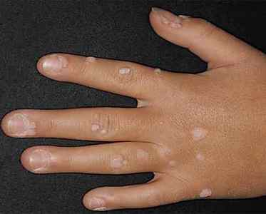 Папіломи на шкірі: причини, лікування, діагностика