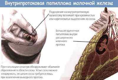 Папіломи на сосках при вагітності: способи видалення