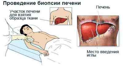 Папіломи в печінці: ефективне лікування захворювання
