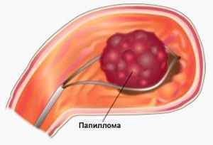 Папіломи в шлунку: причини, способи лікування і фото