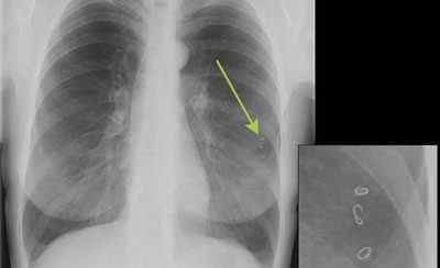 Паразити в легенях людини: симптоми і лікування