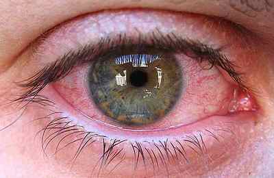 Паразити в очах людини: симптоми і фото очних глистів